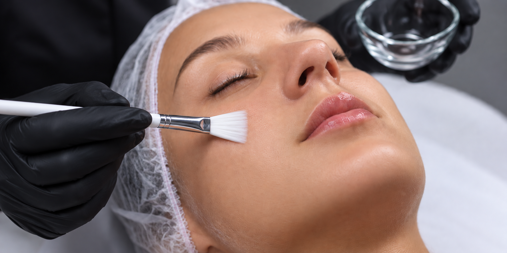 Superficial peel treatment
