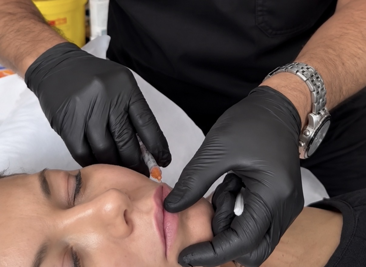 Dermal filler treatment